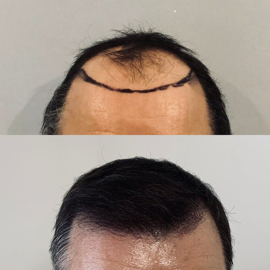 Harris Hair Transplant UK - Harris Hair Transplant UK