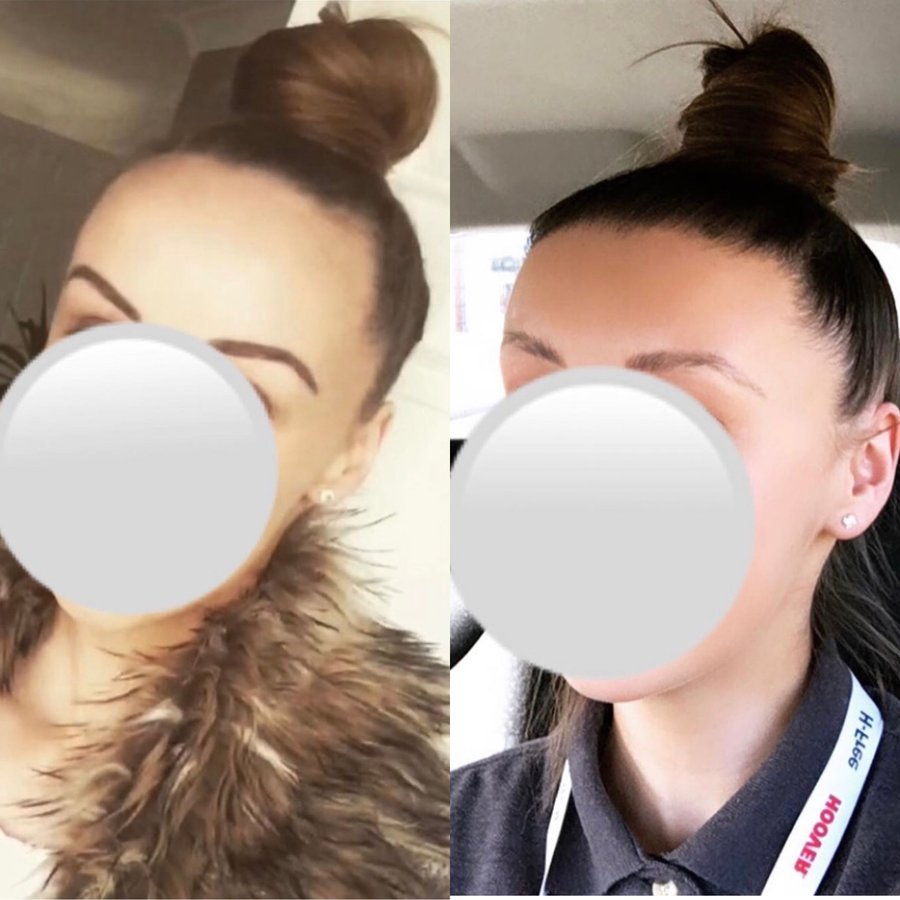 Harris Hair Transplant UK - Harris Hair Transplant UK