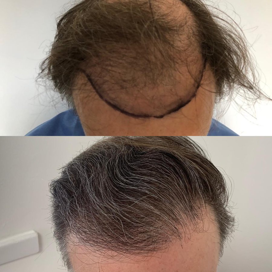 Harris Hair Transplant UK - Harris Hair Transplant UK