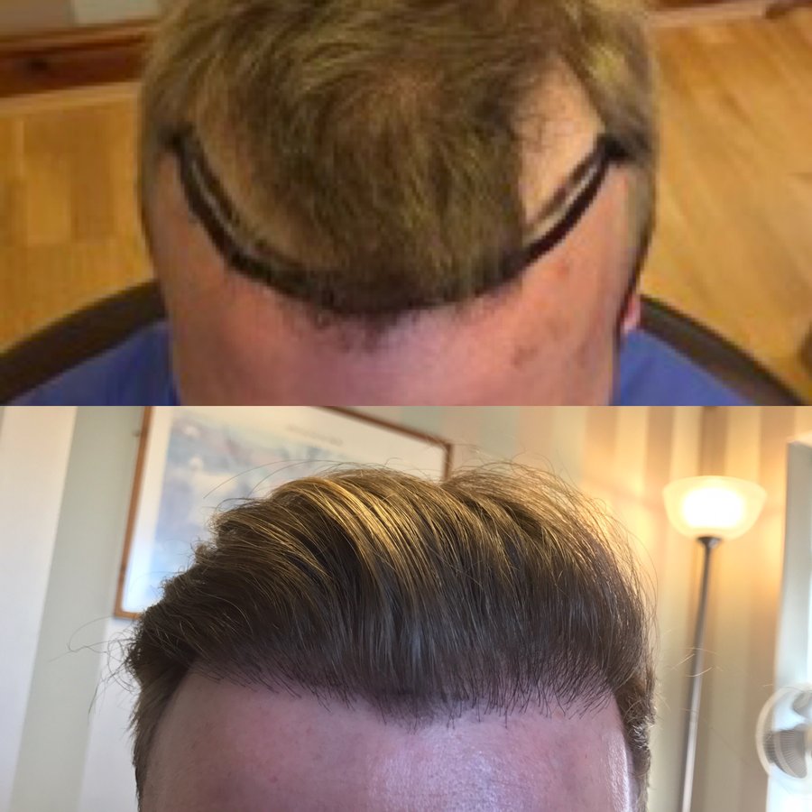 Harris Hair Transplant UK - Harris Hair Transplant UK