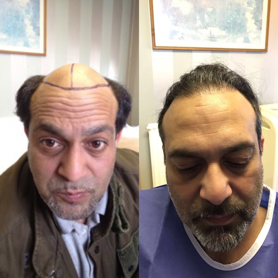 Harris Hair Transplant UK - Harris Hair Transplant UK