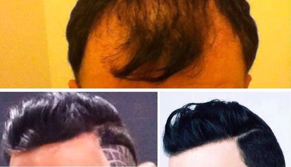 Harris Hair Transplant UK - Harris Hair Transplant UK