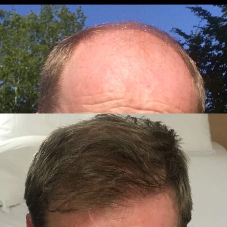 Harris Hair Transplant UK - Harris Hair Transplant UK