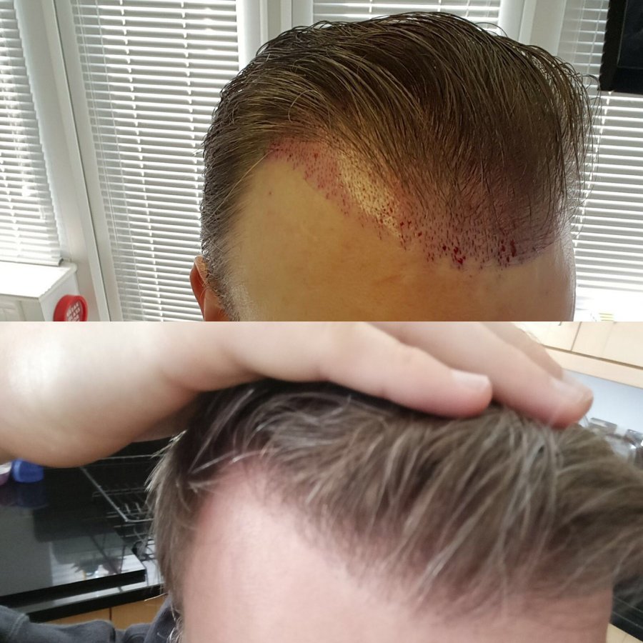 Harris Hair Transplant UK - Harris Hair Transplant UK