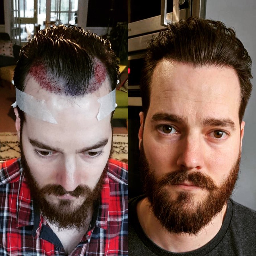 Harris Hair Transplant UK - Harris Hair Transplant UK