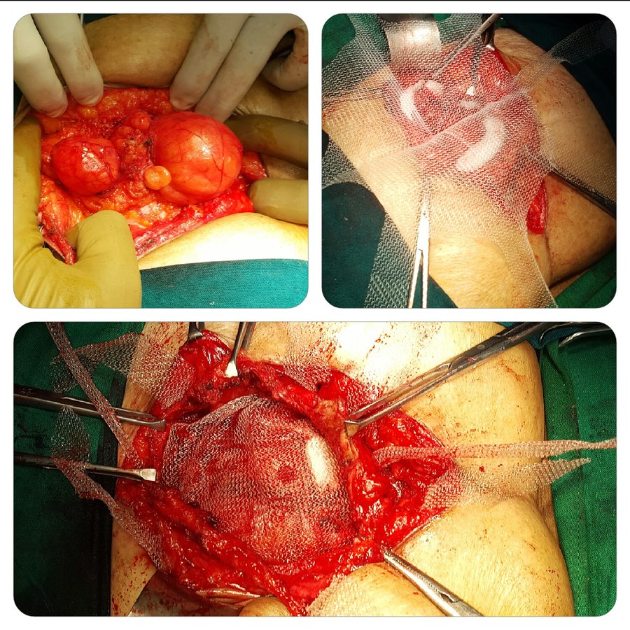 Hernia Repair Clinic - Hernia Repair Clinic