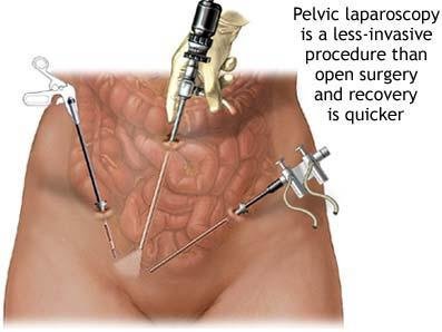 Hernia Surgery India - Hernia Surgery India