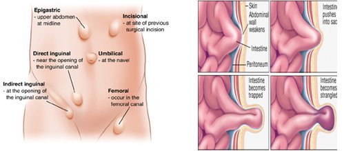 Hernia Surgery India - Hernia Surgery India