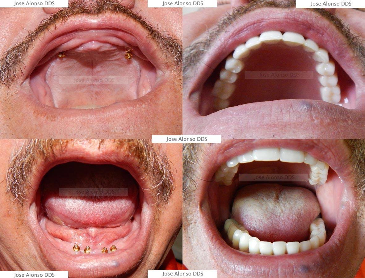 Hispadent - Jose Alonso MD, DDS, FACS - Hispadent - Jose Alonso MD, DDS, FACS