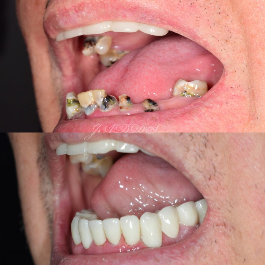 Hispadent - Jose Alonso MD, DDS, FACS - Hispadent - Jose Alonso MD, DDS, FACS