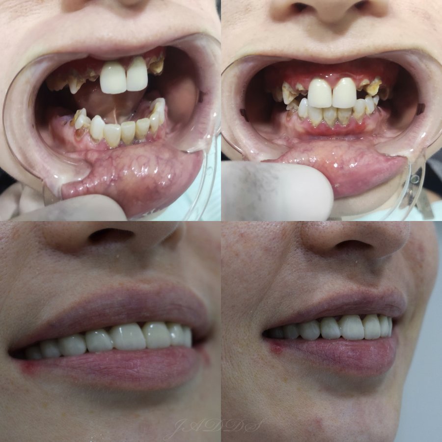 Hispadent - Jose Alonso MD, DDS, FACS - Hispadent - Jose Alonso MD, DDS, FACS