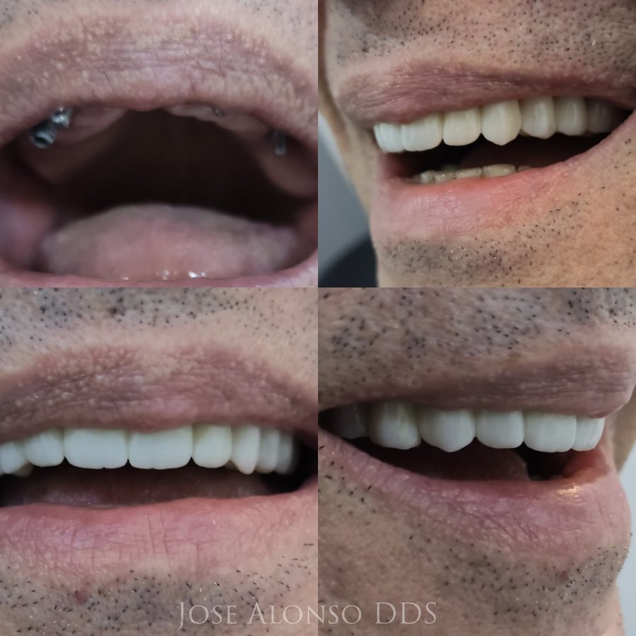Hispadent - Jose Alonso MD, DDS, FACS - Hispadent - Jose Alonso MD, DDS, FACS