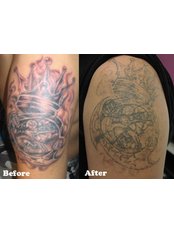 Hong Kong Laser Tattoo Removal Clinic - Hong Kong Laser Tattoo Removal Clinic