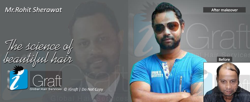 iGraft Global Hair Services-Bangalore - iGraft Global Hair Services-Bangalore