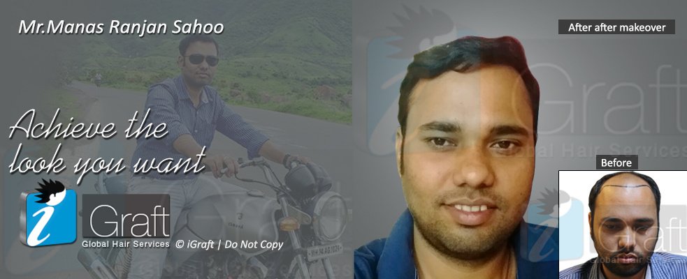 iGraft Global Hair Services-Bangalore - iGraft Global Hair Services-Bangalore