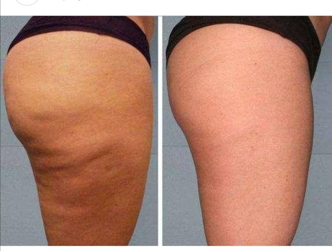 مركز لازر I-Lipo - I-Lipo Lazer Centre