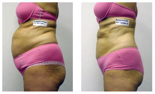 مركز لازر I-Lipo - I-Lipo Lazer Centre