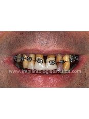 Implantología Estética. Dr. Cuesta - Bilbao Center - Implantología Estética. Dr. Cuesta - Bilbao Center