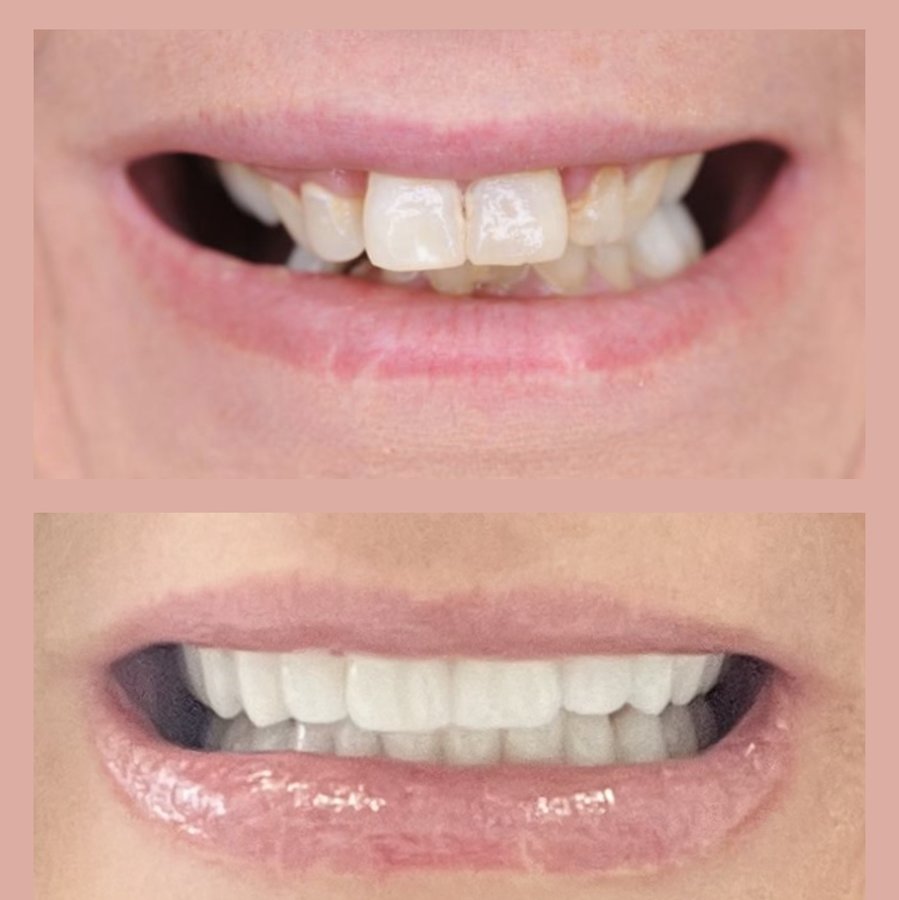 Impression Dent - Impression Dent