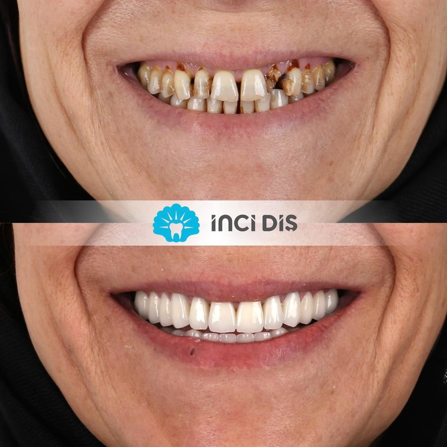 İnci Diş - İnci Diş