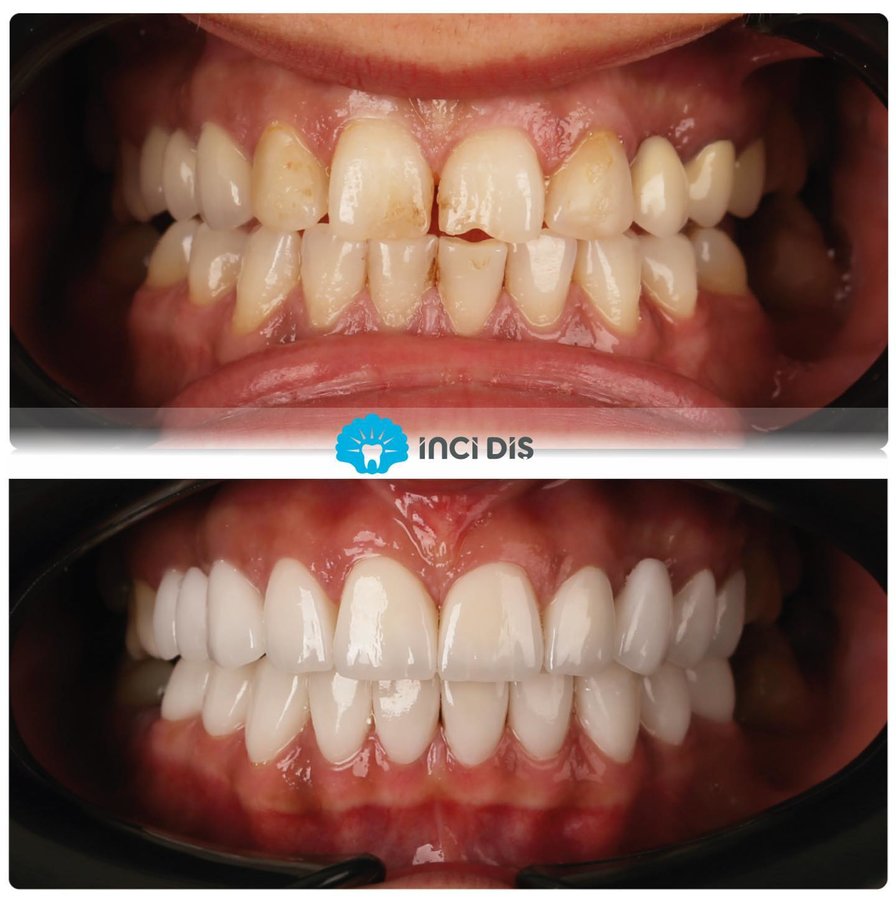 İnci Diş - İnci Diş