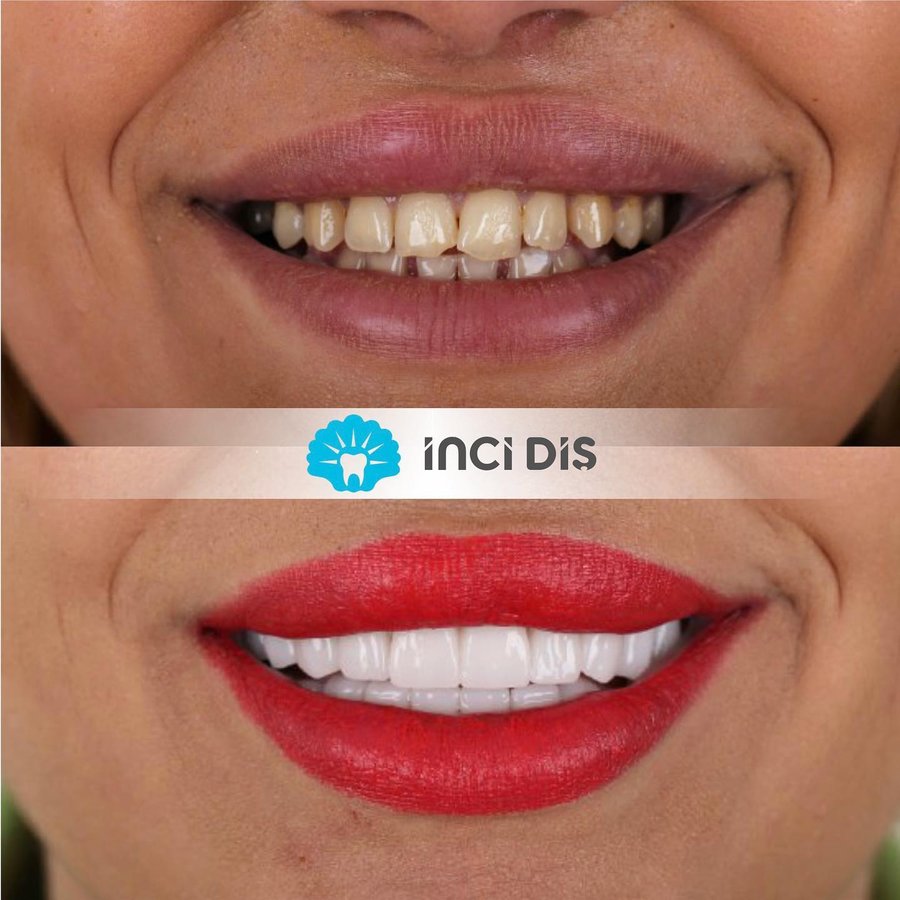 İnci Diş - İnci Diş