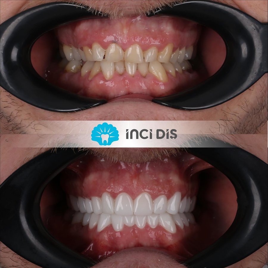 İnci Diş - İnci Diş