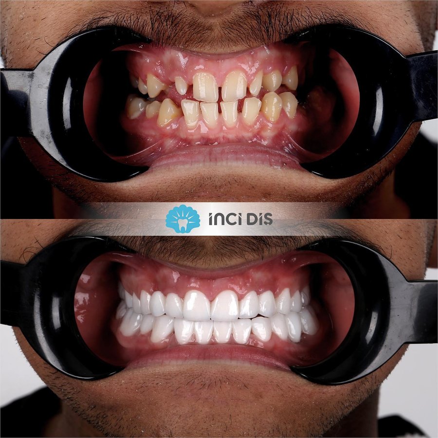 İnci Diş - İnci Diş