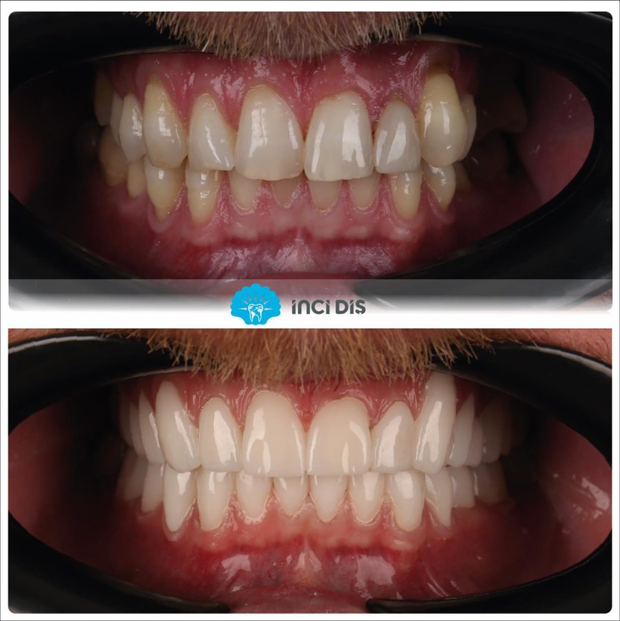 İnci Diş - İnci Diş