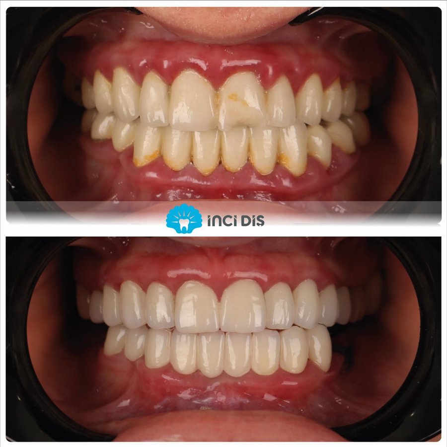 İnci Diş - İnci Diş