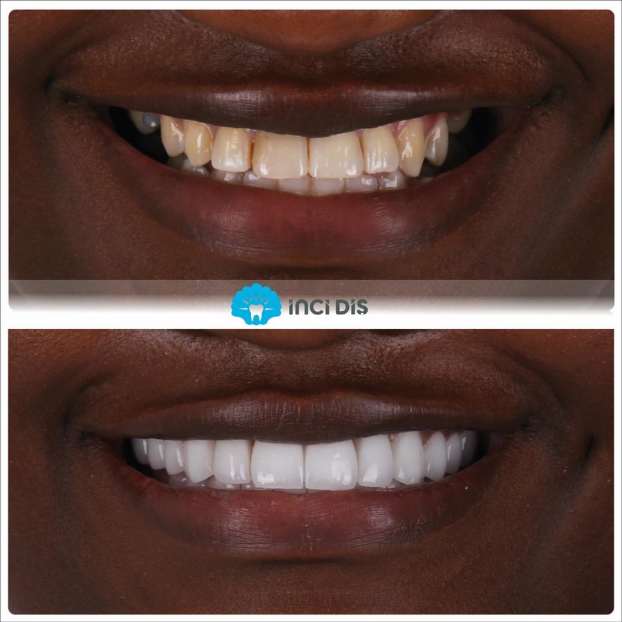 İnci Diş - İnci Diş