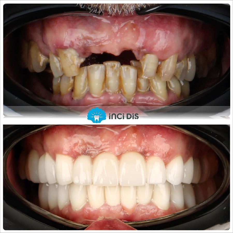 İnci Diş - İnci Diş