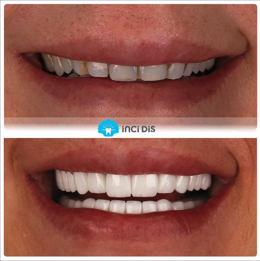 İnci Diş - İnci Diş