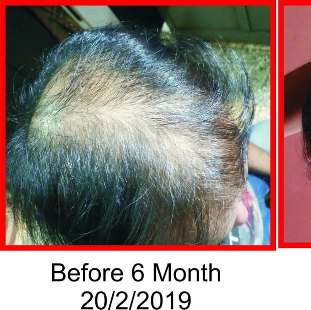 Insta Hair Transplant & International Hair Labs-PUNE - Insta Hair Transplant & International Hair Labs-PUNE