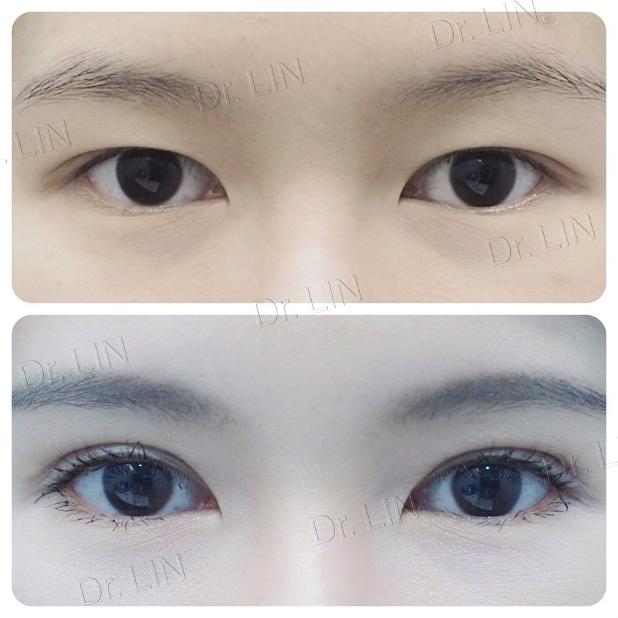 InZ Eyelid Surgery Clinic - InZ Eyelid Surgery Clinic
