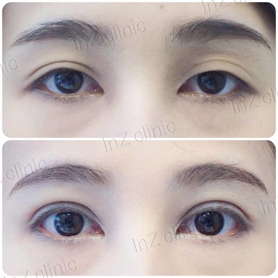 InZ Eyelid Surgery Clinic - InZ Eyelid Surgery Clinic