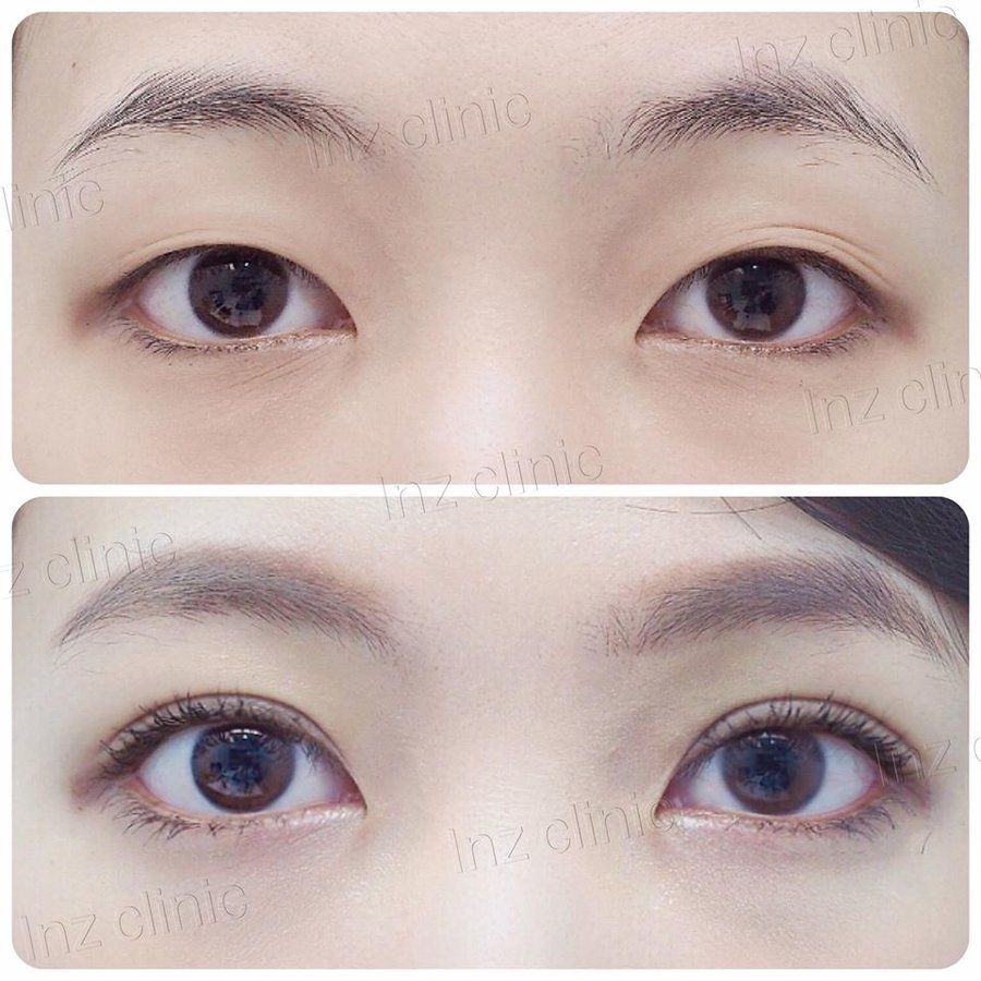 InZ Eyelid Surgery Clinic - InZ Eyelid Surgery Clinic