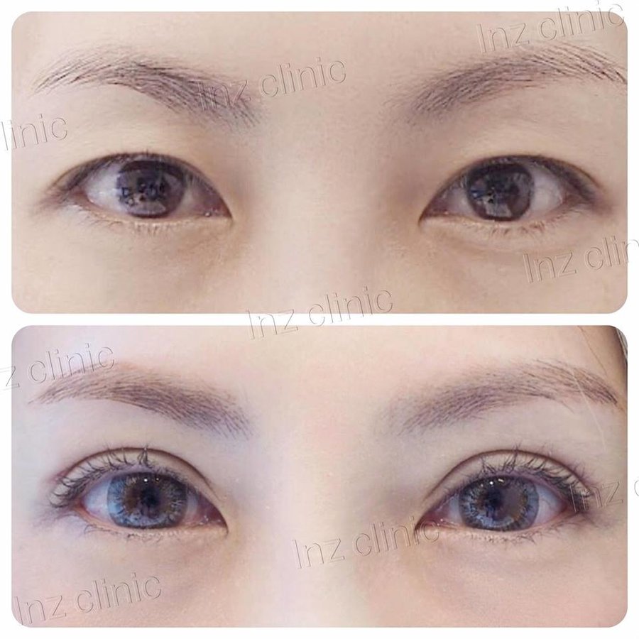 InZ Eyelid Surgery Clinic - InZ Eyelid Surgery Clinic