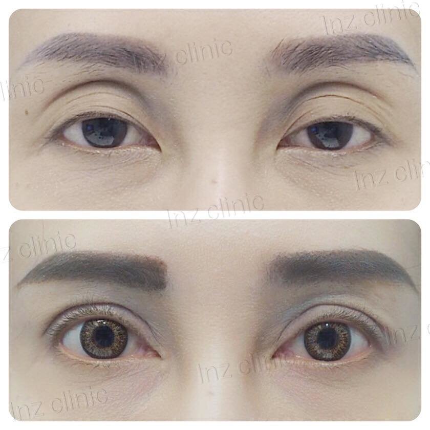 InZ Eyelid Surgery Clinic - InZ Eyelid Surgery Clinic