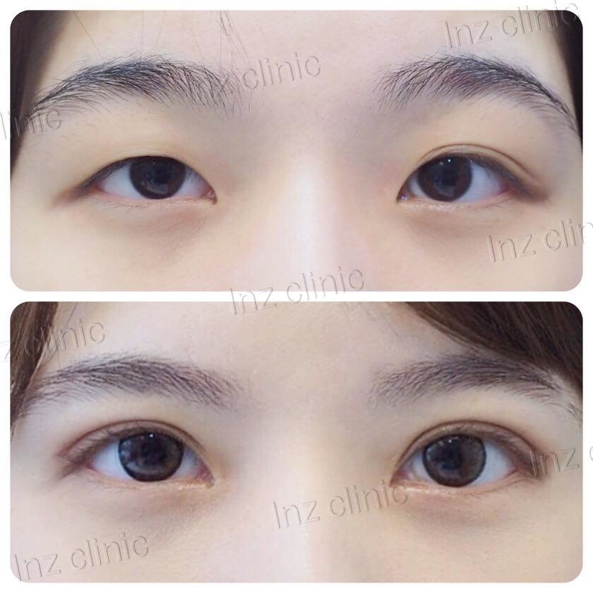 InZ Eyelid Surgery Clinic - InZ Eyelid Surgery Clinic