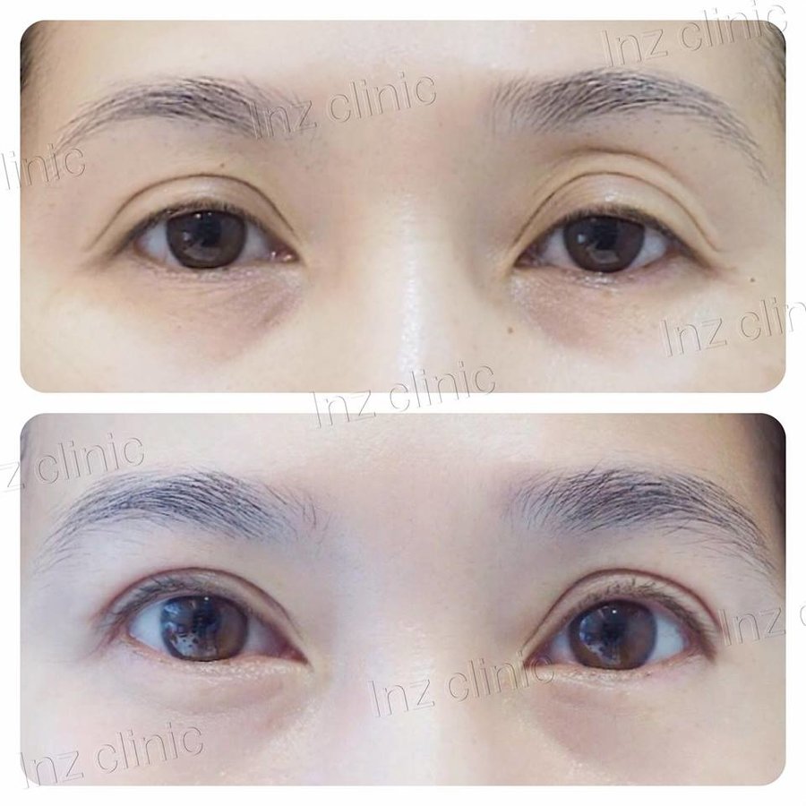 InZ Eyelid Surgery Clinic - InZ Eyelid Surgery Clinic