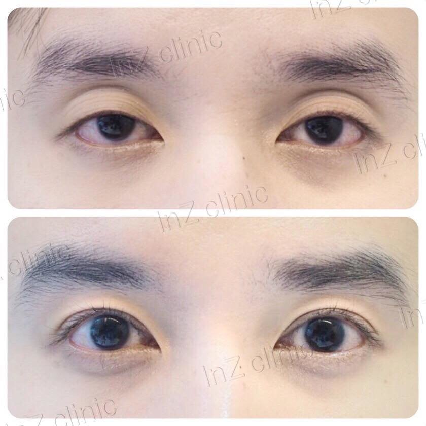 InZ Eyelid Surgery Clinic - InZ Eyelid Surgery Clinic