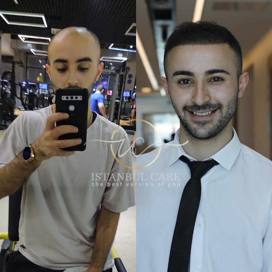 Istanbul Care, Hair Transplant In Turkey - Istanbul Care, Hair Transplant In Turkey