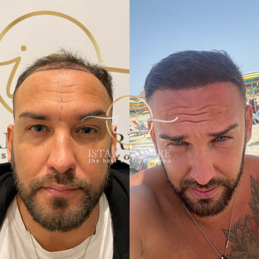 Istanbul Care, Hair Transplant In Turkey - Istanbul Care, Hair Transplant In Turkey