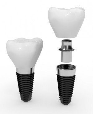 مركز اسطنبول لزراعة الأسنان البيئية - Istanbul Implant and Ecological Dentistry Centre