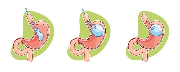 إيزميربيرياتريكس - izmirbariatrics