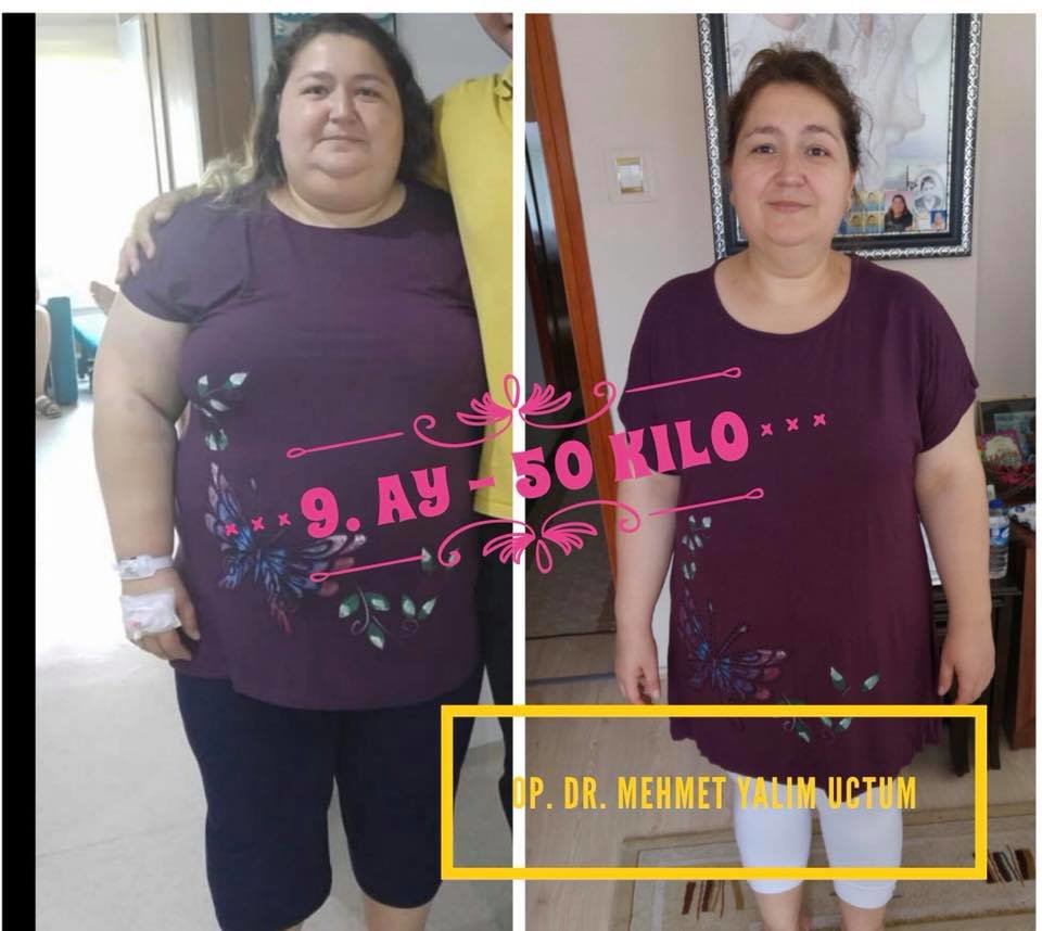 إيزميربيرياتريكس - izmirbariatrics