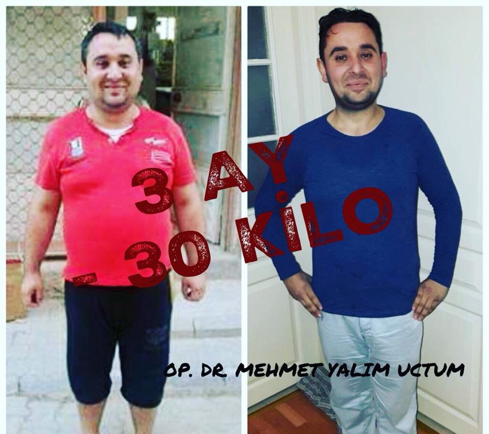 إيزميربيرياتريكس - izmirbariatrics