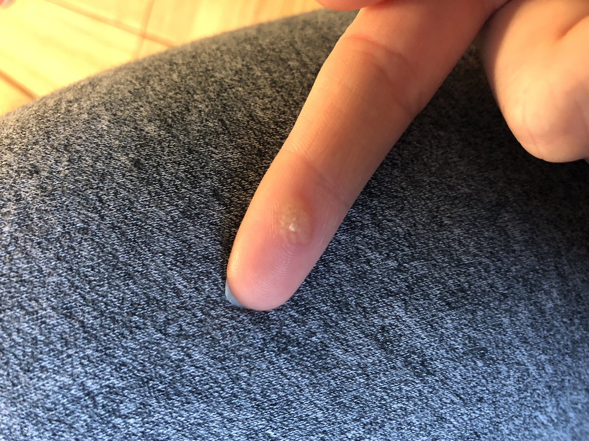 Jane Hancy Specialist in Electrolysis BIAE - Jane Hancy Specialist in Electrolysis BIAE