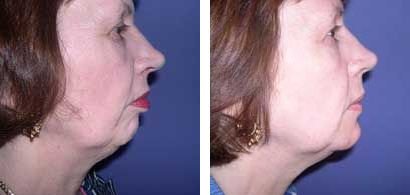 Kapositas - Salonika - Kapositas - Salonika